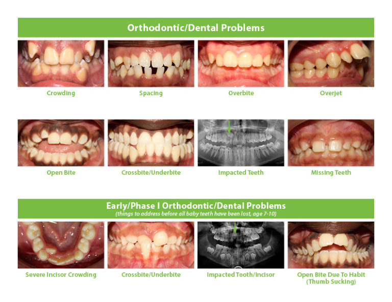 Types Of Teeth Alignment Problems