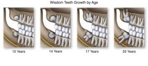 wisdom teeth progression